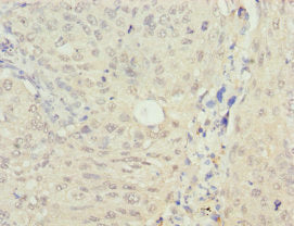 Immunohistochemistry of paraffin-embedded human lung cancer using RAE1 Antibody at dilution of 1: 100Rabbit anti-Human RAE1 Polyclonal Antibody