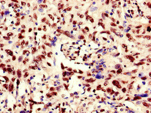 Immunohistochemistry of paraffin-embedded human lung cancer using RBM10 Antibody at dilution of 1:100Rabbit anti-Human RBM10 Polyclonal Antibody