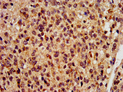 IHC image of RBFOX2 Antibody diluted at 1:400 and staining in paraffin-embedded human glioma performed on a Leica BondTM system. After dewaxing and hydration, antigen retrieval was mediated by high pressure in a citrate buffer (pH 6.0). Section was blocked with 10% normal goat serum 30min at RT. Then primary antibody (1% BSA) was incubated at 4°C overnight. The primary is detected by a biotinylated secondary antibody and visualized using an HRP conjugated SP system.Rabbit anti-Human RBFOX2 Polyclonal Antibody