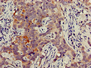 Immunohistochemistry of paraffin-embedded human pancreatic cancer using JAG1 Antibody at dilution of 1:100