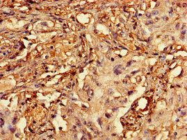 Immunohistochemistry of paraffin-embedded human lung cancer using RCBTB2 Antibody at dilution of 1:100Rabbit anti-Human RCBTB2 Polyclonal Antibody