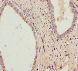 Immunohistochemistry of paraffin-embedded human prostate cancer using RDH11 Antibody at dilution of 1:100Rabbit anti-Human RDH11 Polyclonal Antibody
