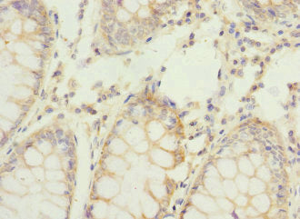 Immunohistochemistry of paraffin-embedded human colon cancer using REC8 Antibody at dilution of 1:100Rabbit anti-Human REC8 Polyclonal Antibody
