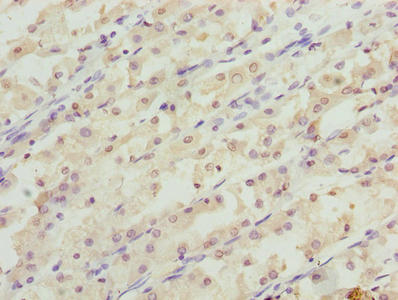 Immunohistochemistry of paraffin-embedded human gastric cancer using the antibody at dilution of 1:100Rabbit anti-Human RER1 Polyclonal Antibody