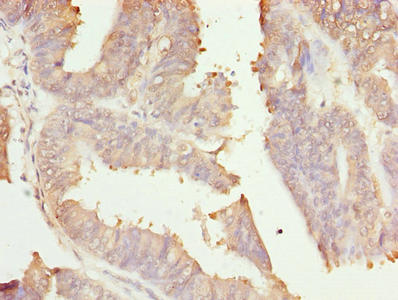 Immunohistochemistry of paraffin-embedded human endometrial cancer using RER1 Antibody at dilution of 1:100Rabbit anti-Human RER1 Polyclonal Antibody