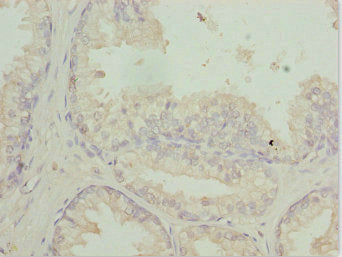 Immunohistochemistry of paraffin-embedded human prostate cancer using RFPL2 Antibody at dilution of 1:100Rabbit anti-Human RFPL2 Polyclonal Antibody
