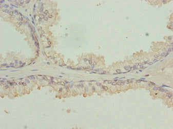 Immunohistochemistry of paraffin-embedded human prostate cancer using RFPL2 Antibody at dilution of 1:100Rabbit anti-Human RFPL2 Polyclonal Antibody