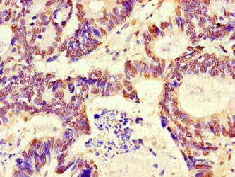 Immunohistochemistry of paraffin-embedded human colon cancer using RFPL4B Antibody at dilution of 1:100Rabbit anti-Human RFPL4B Polyclonal Antibody