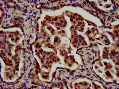 IHC image of RFX1 Antibody diluted at 1:700 and staining in paraffin-embedded human lung cancer performed on a Leica BondTM system. After dewaxing and hydration, antigen retrieval was mediated by high pressure in a citrate buffer (pH 6.0). Section was blocked with 10% normal goat serum 30min at RT. Then primary antibody (1% BSA) was incubated at 4°C overnight. The primary is detected by a biotinylated secondary antibody and visualized using an HRP conjugated SP system.Rabbit anti-Human RFX1 Polyclonal Antibody