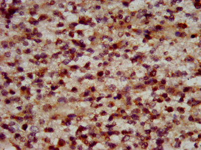 IHC image of RFX2 Antibody diluted at 1:600 and staining in paraffin-embedded human glioma performed on a Leica BondTM system. After dewaxing and hydration, antigen retrieval was mediated by high pressure in a citrate buffer (pH 6.0). Section was blocked with 10% normal goat serum 30min at RT. Then primary antibody (1% BSA) was incubated at 4°C overnight. The primary is detected by a biotinylated secondary antibody and visualized using an HRP conjugated SP system.Rabbit anti-Human RFX2 Polyclonal Antibody