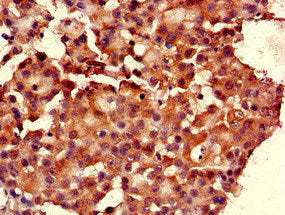 Immunohistochemistry of paraffin-embedded human breast cancer using the antibody at dilution of 1:100Rabbit anti-Human RGS19 Polyclonal Antibody