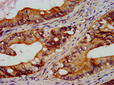 IHC image of RGS6 Antibody diluted at 1:300 and staining in paraffin-embedded human colon cancer performed on a Leica BondTM system. After dewaxing and hydration, antigen retrieval was mediated by high pressure in a citrate buffer (pH 6.0). Section was blocked with 10% normal goat serum 30min at RT. Then primary antibody (1% BSA) was incubated at 4°C overnight. The primary is detected by a biotinylated secondary antibody and visualized using an HRP conjugated SP system.