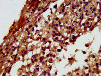 IHC image of RGS6 Antibody diluted at 1:300 and staining in paraffin-embedded human melanoma performed on a Leica BondTM system. After dewaxing and hydration, antigen retrieval was mediated by high pressure in a citrate buffer (pH 6.0). Section was blocked with 10% normal goat serum 30min at RT. Then primary antibody (1% BSA) was incubated at 4°C overnight. The primary is detected by a biotinylated secondary antibody and visualized using an HRP conjugated SP system.