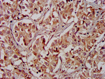 IHC image of RIPK2 Antibody diluted at 1:400 and staining in paraffin-embedded human liver cancer performed on a Leica BondTM system. After dewaxing and hydration, antigen retrieval was mediated by high pressure in a citrate buffer (pH 6.0). Section was blocked with 10% normal goat serum 30min at RT. Then primary antibody (1% BSA) was incubated at 4°C overnight. The primary is detected by a biotinylated secondary antibody and visualized using an HRP conjugated SP system.Rabbit anti-Human RIPK2 Polyclonal Antibody