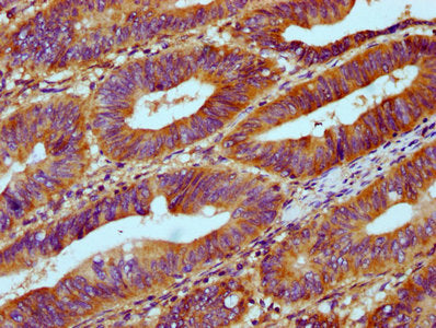 IHC image of RNASEH1 Antibody diluted at 1:300 and staining in paraffin-embedded human colon cancer performed on a Leica BondTM system. After dewaxing and hydration, antigen retrieval was mediated by high pressure in a citrate buffer (pH 6.0). Section was blocked with 10% normal goat serum 30min at RT. Then primary antibody (1% BSA) was incubated at 4°C overnight. The primary is detected by a biotinylated secondary antibody and visualized using an HRP conjugated SP system.Rabbit anti-Human RNASEH1 Polyclonal Antibody
