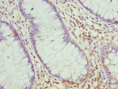 Immunohistochemistry of paraffin-embedded human colon cancer using RNF10 Antibody at dilution of 1:100Rabbit anti-Human RNF10 Polyclonal Antibody
