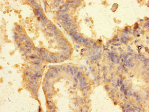 Immunohistochemistry of paraffin-embedded human endometrial tissue using RNF103 Antibody at dilution of 1:100Rabbit anti-Human RNF103 Polyclonal Antibody
