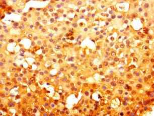 Immunohistochemistry of paraffin-embedded human breast cancer using RNF103 Antibody at dilution of 1:100Rabbit anti-Human RNF103 Polyclonal Antibody