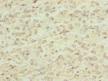 Immunohistochemistry of paraffin-embedded human glioma using RNF13 Antibody at dilution of 1:100Rabbit anti-Human RNF13 Polyclonal Antibody