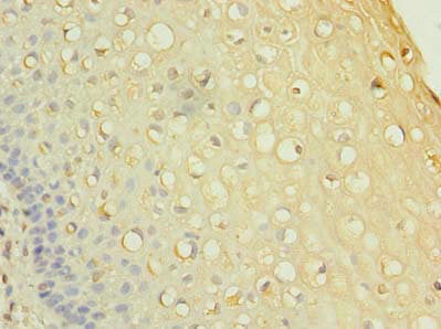 Immunohistochemistry of paraffin-embedded human cervical cancer using RNF148 Antibody at dilution of 1:100Rabbit anti-Human RNF148 Polyclonal Antibody