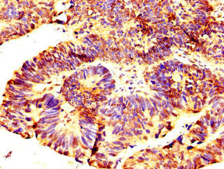 IHC image of RNF219 Antibody diluted at 1:300 and staining in paraffin-embedded human ovarian cancer performed on a Leica BondTM system. After dewaxing and hydration, antigen retrieval was mediated by high pressure in a citrate buffer (pH 6.0). Section was blocked with 10% normal goat serum 30min at RT. Then primary antibody (1% BSA) was incubated at 4°C overnight. The primary is detected by a biotinylated secondary antibody and visualized using an HRP conjugated SP system.Rabbit anti-Human RNF219 Polyclonal Antibody