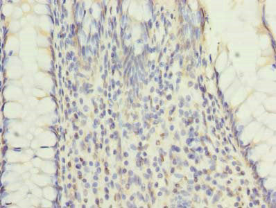 Immunohistochemistry of paraffin-embedded human colon cancer using RNF26 Antibody at dilution of 1:100Rabbit anti-Human RNF26 Polyclonal Antibody