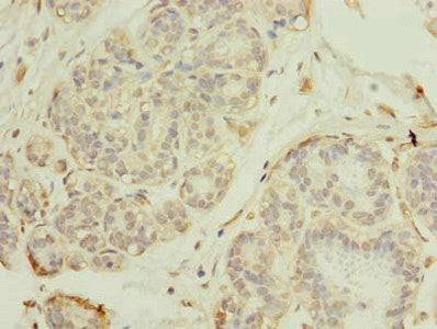 Immunohistochemistry of paraffin-embedded human breast cancer using RNF26 Antibody at dilution of 1:100Rabbit anti-Human RNF26 Polyclonal Antibody