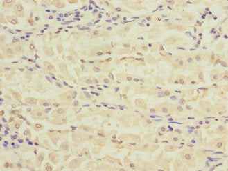 Immunohistochemistry of paraffin-embedded human gastric cancer using RPIA Antibody at dilution of 1:100Rabbit anti-Human RPIA Polyclonal Antibody