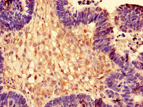 Immunohistochemistry of paraffin-embedded human ovarian cancer using the antibody at dilution of 1:100Rabbit anti-Human RPL28 Polyclonal Antibody