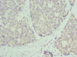 Immunohistochemistry of paraffin-embedded human gastric cancer using RPL9 Antibody at dilution of 1:100Rabbit anti-Human RPL9 Polyclonal Antibody