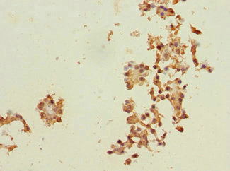 Immunohistochemistry of paraffin-embedded human breast cancer using RPN2 Antibody at dilution of 1:100Rabbit anti-Human RPN2 Polyclonal Antibody