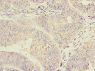 Immunohistochemistry of paraffin-embedded human endometrial cancer using RPN2 Antibody at dilution of 1:100Rabbit anti-Human RPN2 Polyclonal Antibody