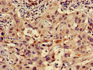 Immunohistochemistry of paraffin-embedded human lung cancer using RPS15 Antibody at dilution of 1:100Rabbit anti-Human RPS15 Polyclonal Antibody