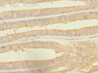 Immunohistochemistry of paraffin-embedded human endometrial cancer using RPS27 Antibody at dilution of 1:100Rabbit anti-Human RPS27 Polyclonal Antibody