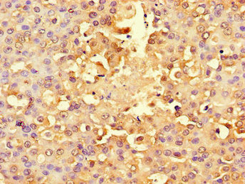 Immunohistochemistry of paraffin-embedded human breast cancer using the antibody at dilution of 1:100Rabbit anti-Human RPS6 Polyclonal Antibody