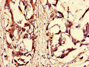 Immunohistochemistry of paraffin-embedded human gastric cancer using RPS6KA4 Antibody at dilution of 1:100Rabbit anti-Human RPS6KA4 Polyclonal Antibody