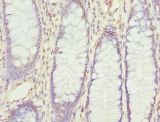Immunohistochemistry of paraffin-embedded human colon cancer using RPS6KL1 Antibody at dilution of 1:100Rabbit anti-Human RPS6KL1 Polyclonal Antibody