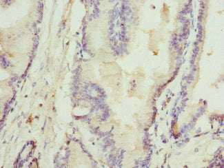 Immunohistochemistry of paraffin-embedded human prostate cancer using RTKN Antibody at dilution of 1:100Rabbit anti-Human RTKN Polyclonal Antibody