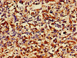 Immunohistochemistry of paraffin-embedded human melanoma using the antibody at dilution of 1:100Rabbit anti-Human RUNX3 Polyclonal Antibody