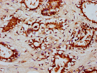 IHC image of RYK Antibody diluted at 1:200 and staining in paraffin-embedded human breast cancer performed on a Leica BondTM system. After dewaxing and hydration, antigen retrieval was mediated by high pressure in a citrate buffer (pH 6.0). Section was blocked with 10% normal goat serum 30min at RT. Then primary antibody (1% BSA) was incubated at 4°C overnight. The primary is detected by a biotinylated secondary antibody and visualized using an HRP conjugated SP system.Rabbit anti-Human RYK Polyclonal Antibody