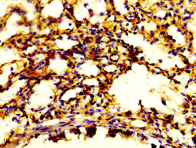 IHC image of S100A4 Antibody diluted at 1:600 and staining in paraffin-embedded human lung tissue performed on a Leica BondTM system. After dewaxing and hydration, antigen retrieval was mediated by high pressure in a citrate buffer (pH 6.0). Section was blocked with 10% normal goat serum 30min at RT. Then primary antibody (1% BSA) was incubated at 4°C overnight. The primary is detected by a biotinylated secondary antibody and visualized using an HRP conjugated SP system.Rabbit anti-Human S100A4 Polyclonal Antibody