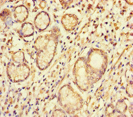 Immunohistochemistry of paraffin-embedded human gastric cancer using S100G Antibody at dilution of 1:100Rabbit anti-Human S100G Polyclonal Antibody