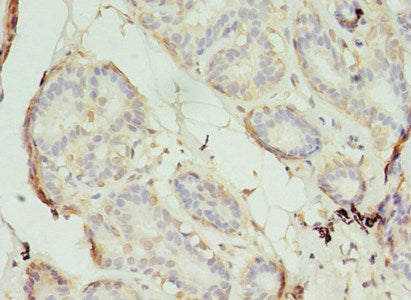 Immunohistochemistry of paraffin-embedded human breast cancer using S1PR1 Antibody at dilution of 1:100Rabbit anti-Human S1PR1 Polyclonal Antibody