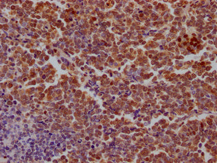 IHC image of SAMHD1 Antibody diluted at 1:100 and staining in paraffin-embedded human lung cancer performed on a Leica BondTM system. After dewaxing and hydration, antigen retrieval was mediated by high pressure in a citrate buffer (pH 6.0). Section was blocked with 10% normal goat serum 30min at RT. Then primary antibody (1% BSA) was incubated at 4°C overnight. The primary is detected by a Goat anti-rabbit IgG labeled by HRP and visualized using 0.05% DAB.Rabbit anti-Human SAMHD1 Polyclonal Antibody