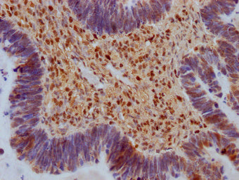 IHC image of SAMHD1 Antibody diluted at 1:100 and staining in paraffin-embedded human ovarian cancer performed on a Leica BondTM system. After dewaxing and hydration, antigen retrieval was mediated by high pressure in a citrate buffer (pH 6.0). Section was blocked with 10% normal goat serum 30min at RT. Then primary antibody (1% BSA) was incubated at 4°C overnight. The primary is detected by a Goat anti-rabbit IgG labeled by HRP and visualized using 0.05% DAB.Rabbit anti-Human SAMHD1 Polyclonal Antibody