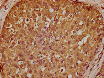 IHC image of SBK2 Antibody diluted at 1:200 and staining in paraffin-embedded human breast cancer performed on a Leica BondTM system. After dewaxing and hydration, antigen retrieval was mediated by high pressure in a citrate buffer (pH 6.0). Section was blocked with 10% normal goat serum 30min at RT. Then primary antibody (1% BSA) was incubated at 4°C overnight. The primary is detected by a biotinylated secondary antibody and visualized using an HRP conjugated SP system.Rabbit anti-Human SBK2 Polyclonal Antibody