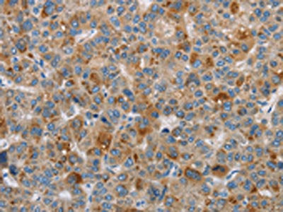 The image on the left is immunohistochemistry of paraffin-embedded Human liver cancer tissue using DBH Antibody(DBH Antibody) at dilution 1/70, on the right is treated with fusion protein. (Original magnification: ×200)Rabbit anti-Human DBH Polyclonal Antibody