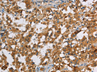 The image on the left is immunohistochemistry of paraffin-embedded Human thyroid cancer tissue using the antibody Antibody) at dilution 1/70, on the right is treated with fusion protein. (Original magnification: ×200)Rabbit anti-Human DBH Polyclonal Antibody