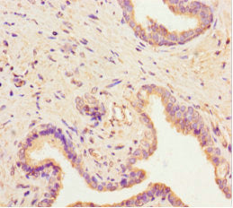 Immunohistochemistry of paraffin-embedded human prostate cancer using SCAMP2 Antibody at dilution of 1:100Rabbit anti-Human SCAMP2 Polyclonal Antibody