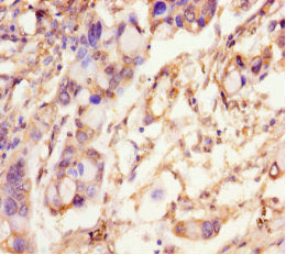 Immunohistochemistry of paraffin-embedded human pancreatic cancer using SCAMP2 Antibody at dilution of 1:100Rabbit anti-Human SCAMP2 Polyclonal Antibody